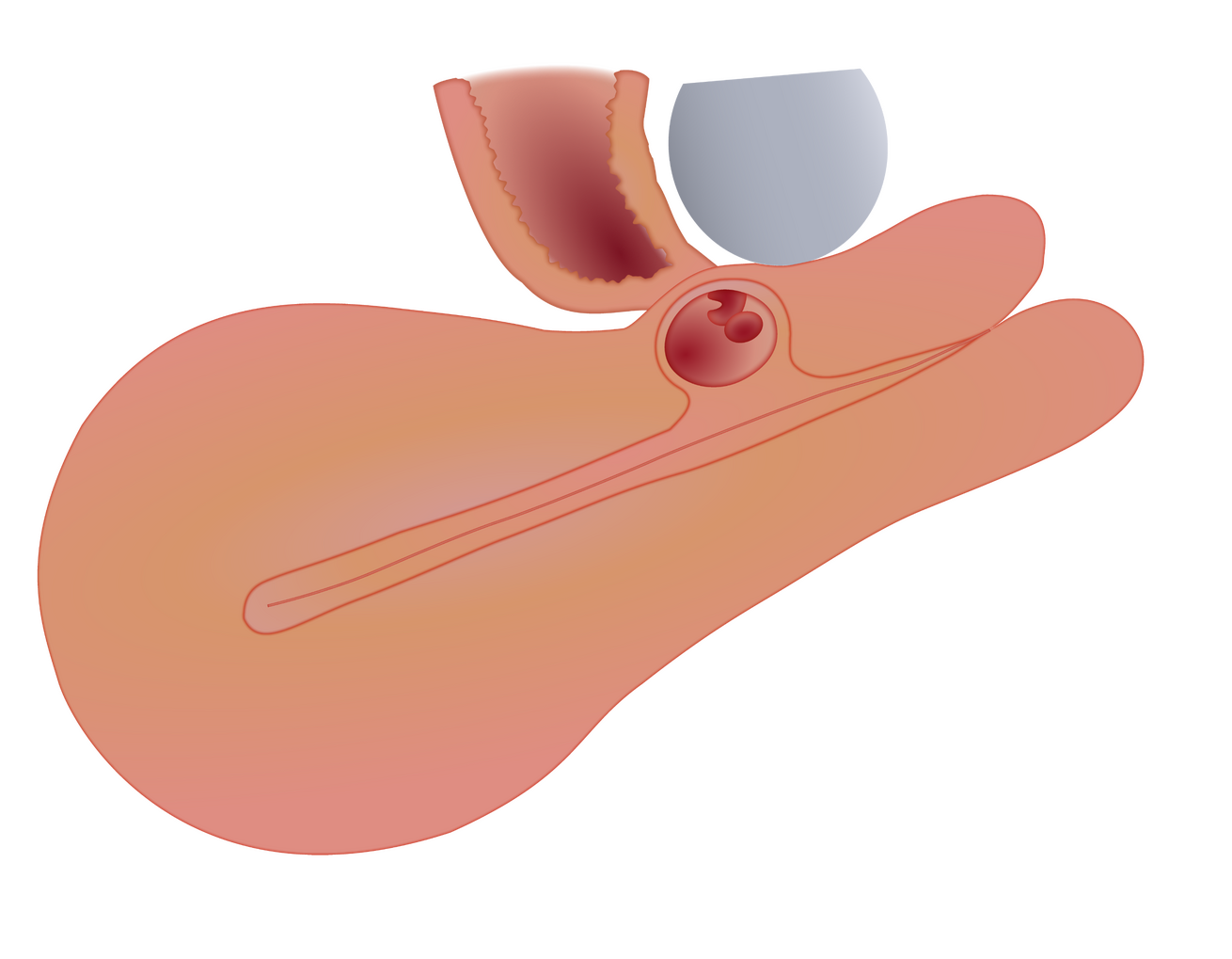 Cesarean scar pregnancy