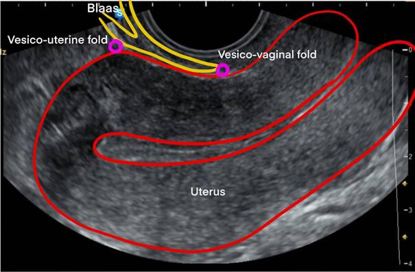Sliding bladder elearning